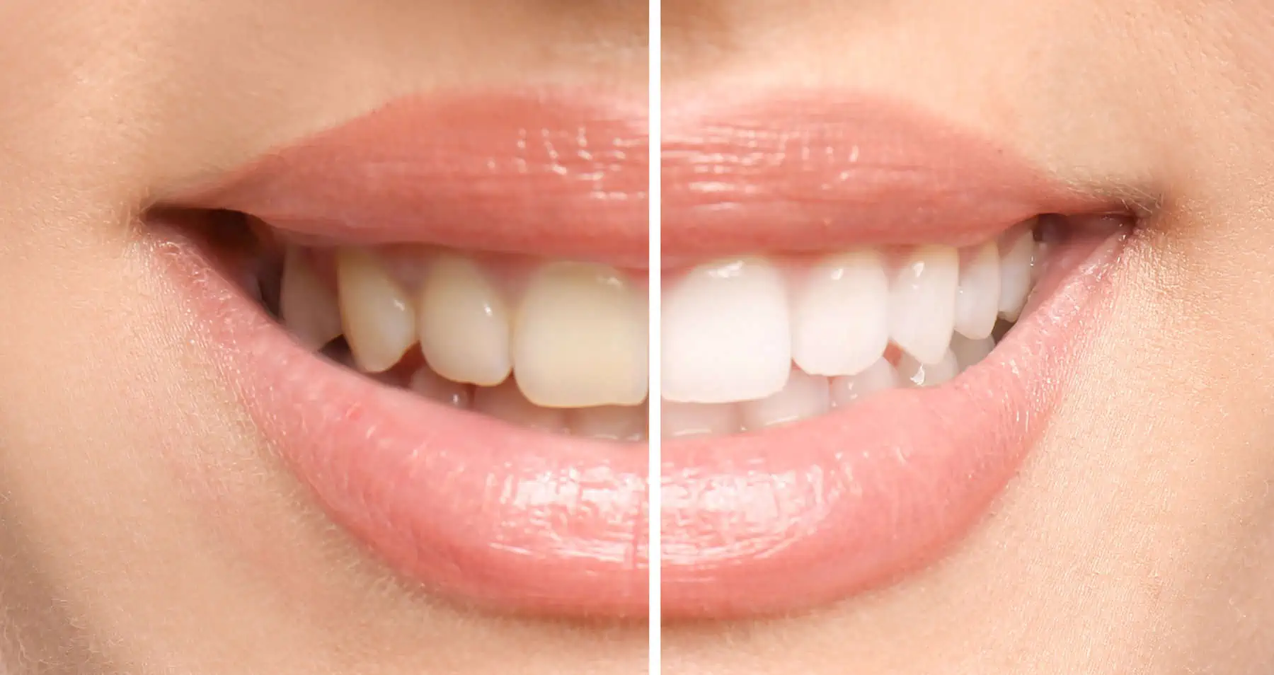 Professional teeth whitening treatment at Kayscreek Dental