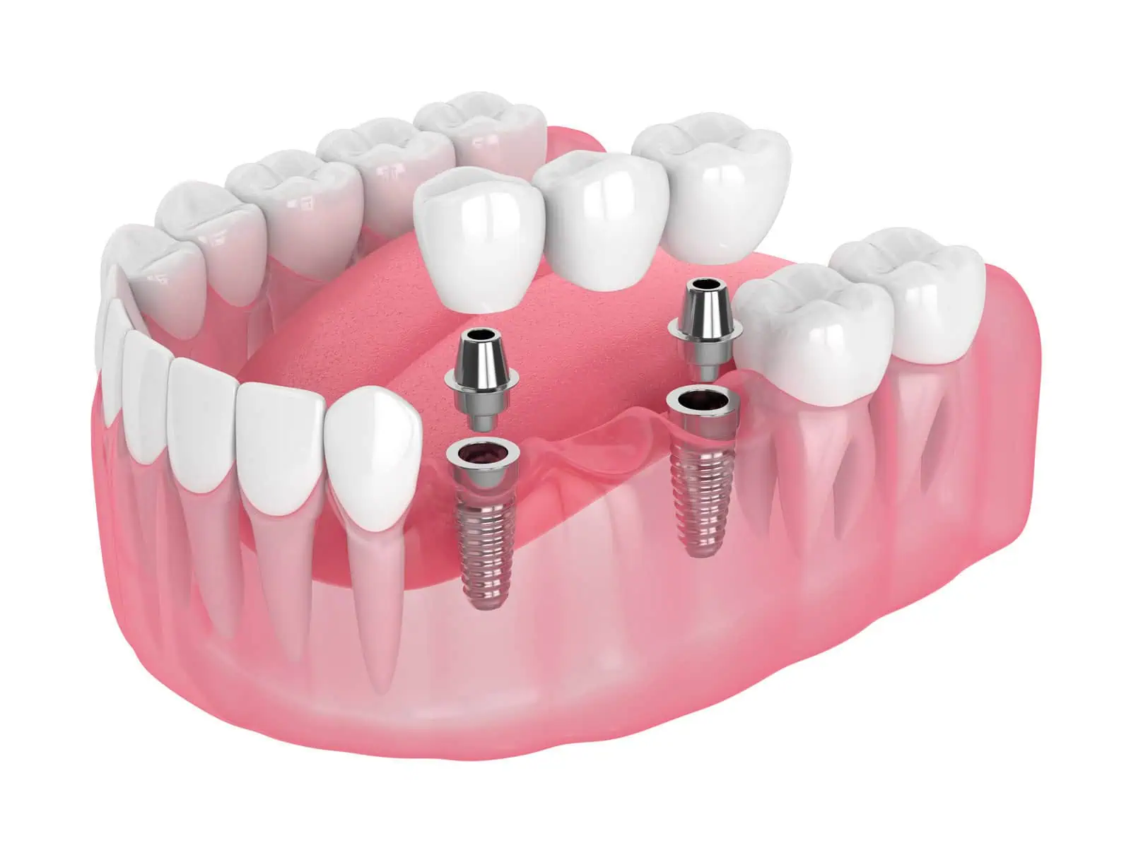 Implant Supported Dentures
