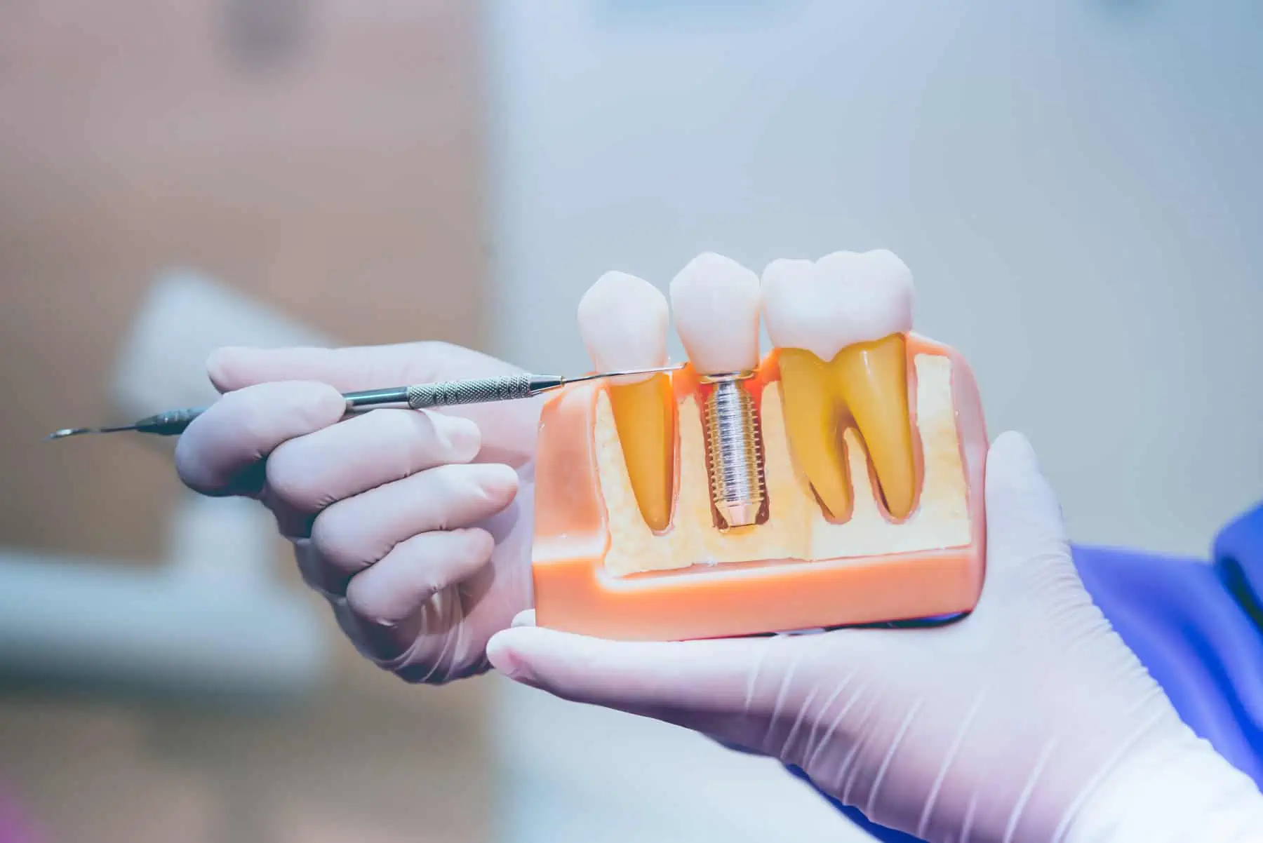 Implant Dentistry