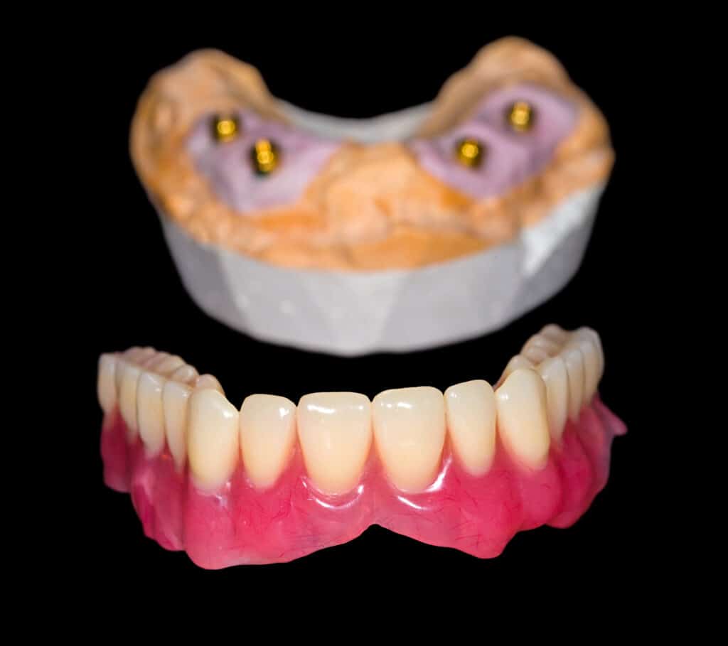 locator dentures layton