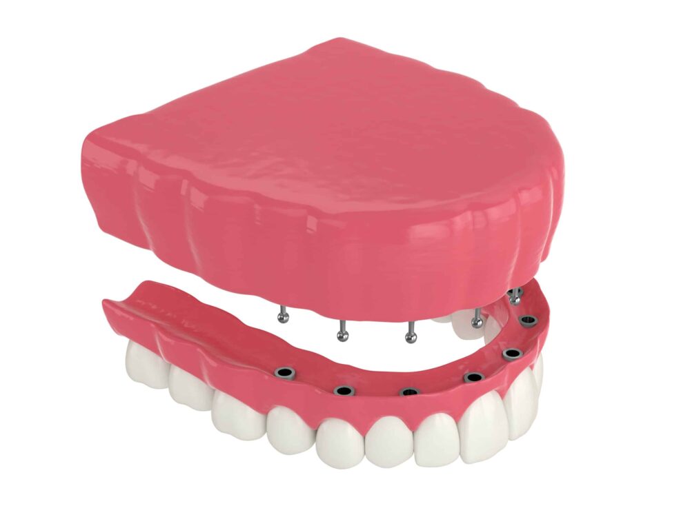 Snap on dentures Layton